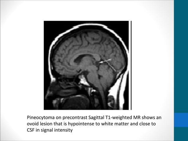 Pineal gland tumors | PPT