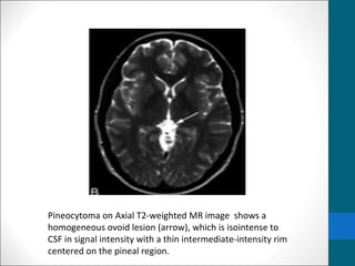 Pineocytoma on Axial T2-weighted MR image shows a 
homogeneous ovoid lesion (arrow), which is isointense to 
CSF in signal intensity with a thin intermediate-intensity rim 
centered on the pineal region. 
 