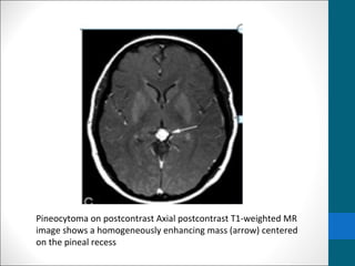 Pineocytoma on postcontrast Axial postcontrast T1-weighted MR 
image shows a homogeneously enhancing mass (arrow) centered 
on the pineal recess 
 