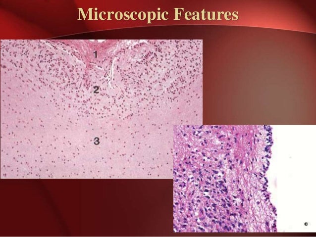 Pineal Cyst Natural Treatment Pineal Cyst Natural Treatment