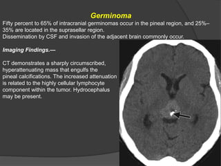Germinoma
Fifty percent to 65% of intracranial germinomas occur in the pineal region, and 25%–
35% are located in the suprasellar region.
Dissemination by CSF and invasion of the adjacent brain commonly occur.
Imaging Findings.—
CT demonstrates a sharply circumscribed,
hyperattenuating mass that engulfs the
pineal calcifications. The increased attenuation
is related to the highly cellular lymphocyte
component within the tumor. Hydrocephalus
may be present.
 