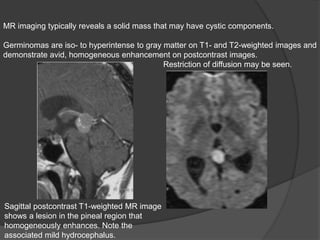 MR imaging typically reveals a solid mass that may have cystic components.
Germinomas are iso- to hyperintense to gray matter on T1- and T2-weighted images and
demonstrate avid, homogeneous enhancement on postcontrast images.
Restriction of diffusion may be seen.
Sagittal postcontrast T1-weighted MR image
shows a lesion in the pineal region that
homogeneously enhances. Note the
associated mild hydrocephalus.
 