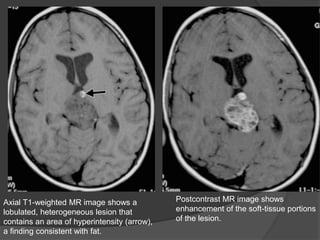 Axial T1-weighted MR image shows a
lobulated, heterogeneous lesion that
contains an area of hyperintensity (arrow),
a finding consistent with fat.
Postcontrast MR image shows
enhancement of the soft-tissue portions
of the lesion.
 