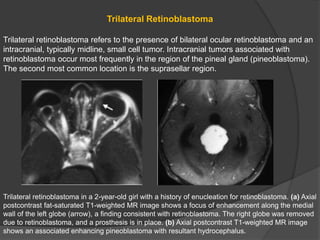 Trilateral Retinoblastoma
Trilateral retinoblastoma refers to the presence of bilateral ocular retinoblastoma and an
intracranial, typically midline, small cell tumor. Intracranial tumors associated with
retinoblastoma occur most frequently in the region of the pineal gland (pineoblastoma).
The second most common location is the suprasellar region.
Trilateral retinoblastoma in a 2-year-old girl with a history of enucleation for retinoblastoma. (a) Axial
postcontrast fat-saturated T1-weighted MR image shows a focus of enhancement along the medial
wall of the left globe (arrow), a finding consistent with retinoblastoma. The right globe was removed
due to retinoblastoma, and a prosthesis is in place. (b) Axial postcontrast T1-weighted MR image
shows an associated enhancing pineoblastoma with resultant hydrocephalus.
 