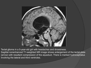 Tectal glioma in a 5-year-old girl with headaches and drowsiness.
Sagittal nonenhanced T1-weighted MR image shows enlargement of the tectal plate
(arrow) with resultant compression of the aqueduct. There is marked hydrocephalus
involving the lateral and third ventricles.
 