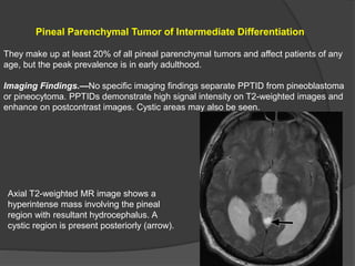 Pineal Parenchymal Tumor of Intermediate Differentiation
They make up at least 20% of all pineal parenchymal tumors and affect patients of any
age, but the peak prevalence is in early adulthood.
Imaging Findings.—No specific imaging findings separate PPTID from pineoblastoma
or pineocytoma. PPTIDs demonstrate high signal intensity on T2-weighted images and
enhance on postcontrast images. Cystic areas may also be seen.
Axial T2-weighted MR image shows a
hyperintense mass involving the pineal
region with resultant hydrocephalus. A
cystic region is present posteriorly (arrow).
 