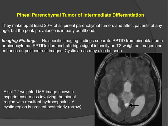 Pineal region masses - radiology | PPTX