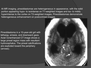 At MR imaging, pineoblastomas are heterogeneous in appearance, with the solid
portion appearing hypo- to isointense on T1-weighted images and iso- to mildly
hyperintense to the cortex on T2-weighted images. Pineoblastomas demonstrate
heterogeneous enhancement on postcontrast images.
Pineoblastoma in a 10-year-old girl with
lethargy, emesis, and downward gaze.
Axial nonenhanced CT image shows a
large pineal region mass with resultant
hydrocephalus. The pineal calcifications
are exploded toward the periphery
(arrows).
 