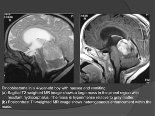 Pineoblastoma in a 4-year-old boy with nausea and vomiting.
(a) Sagittal T2-weighted MR image shows a large mass in the pineal region with
resultant hydrocephalus. The mass is hyperintense relative to gray matter.
(b) Postcontrast T1-weighted MR image shows heterogeneous enhancement within the
mass.
 