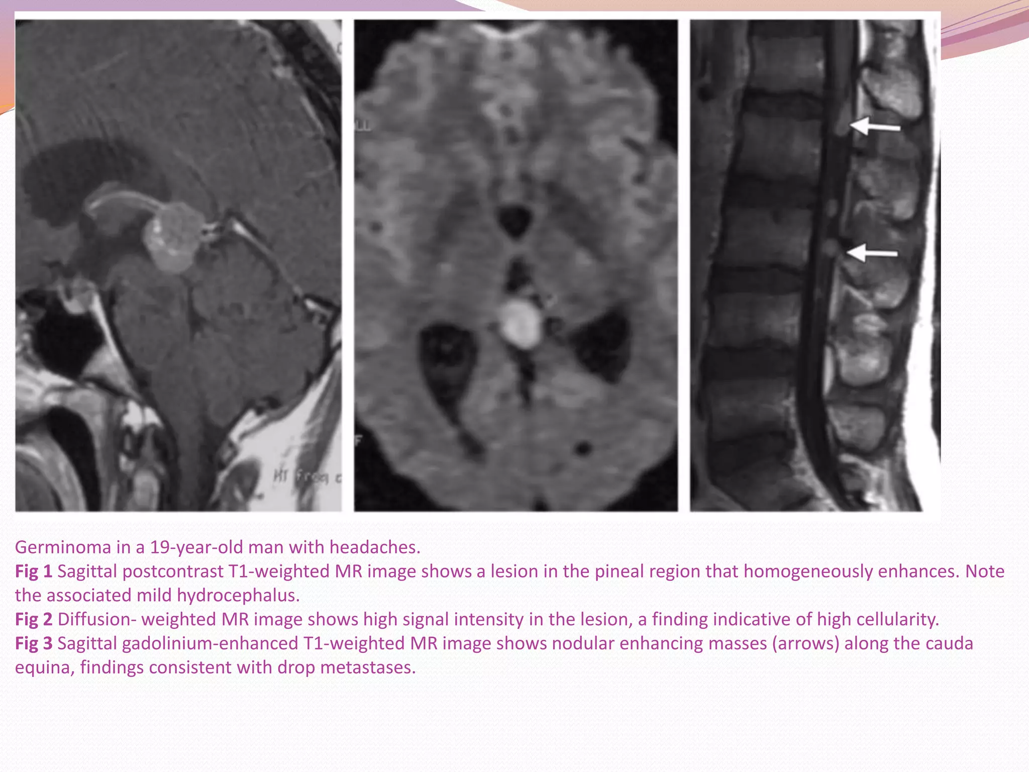 Pineal region tumors | PPTX