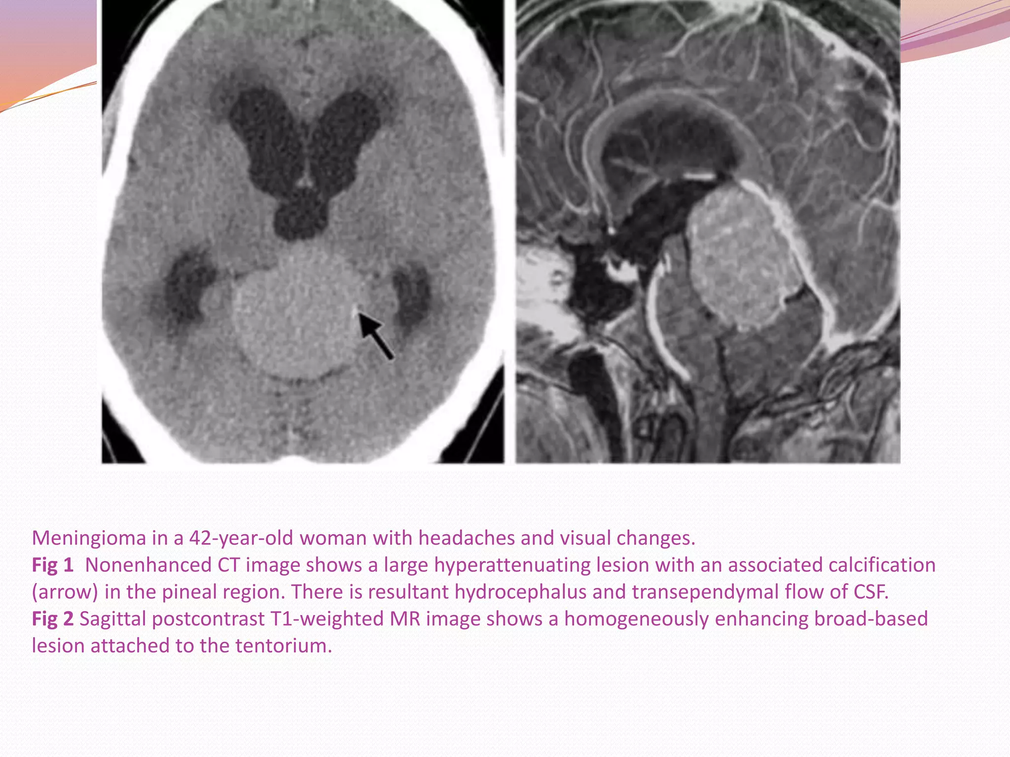 Pineal region tumors | PPTX
