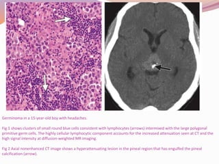 Pineal region tumors | PPTX