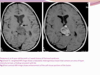 Pineal region tumors | PPTX