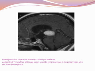 Pineal region tumors | PPTX