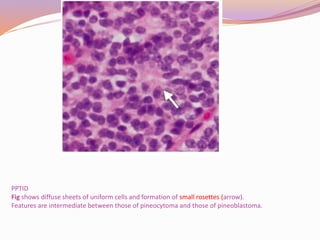 Pineal region tumors | PPTX