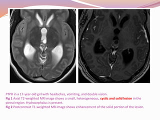 Pineal region tumors | PPTX