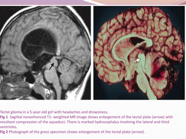 Pineal region tumors | PPTX | Brain and Nervous System Disorders ...