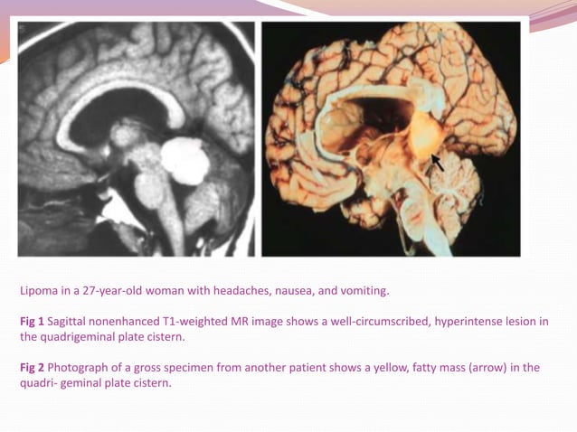 Pineal region tumors | PPTX | Brain and Nervous System Disorders ...