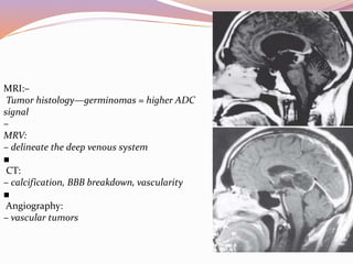Pineal region tumors | PPTX