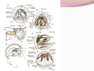 Pineal region tumors | PPTX