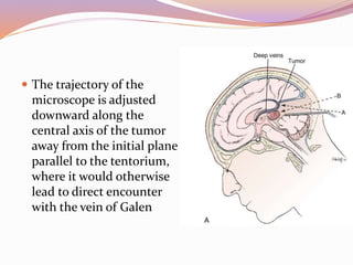 Pineal region tumors | PPTX
