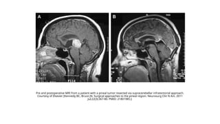 PINEAL REGION TUMORS.pptx radiation oncology | PPTX