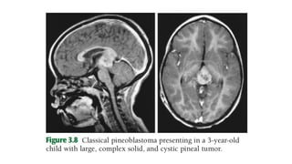 PINEAL REGION TUMORS.pptx radiation oncology | PPTX