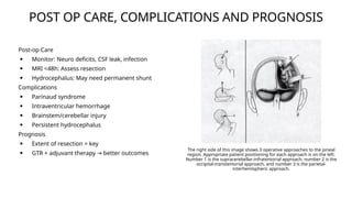 PINEAL REGION TUMORS.pptx radiation oncology | PPTX