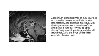 PINEAL REGION TUMORS.pptx radiation oncology | PPTX