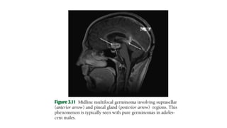PINEAL REGION TUMORS.pptx radiation oncology | PPTX
