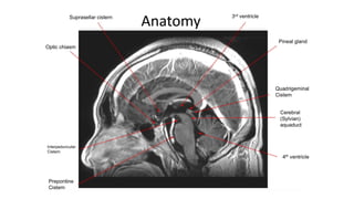 PINEAL REGION TUMORS.pptx radiation oncology | PPTX