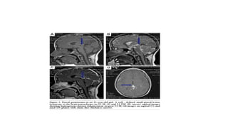 PINEAL REGION TUMORS DIAGNOSIS & SURGICAL APPROACHES.pptx