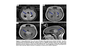 PINEAL REGION TUMORS DIAGNOSIS & SURGICAL APPROACHES.pptx