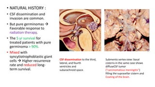 • NATURAL HISTORY :
• CSF dissemination and
invasion are common.
• But pure germinomas 
Favorable response to
radiation therapy.
• The 5 yr survival for
treated patients with pure
germinoma > 90%.
• Mixed with
syncytiotrophoblastic giant
cells  Higher recurrence
rate and reduced long-
term survival.
CSF dissemination to the third,
lateral, and fourth
ventricles and
subarachnoid space.
Submento vertex view: basal
cisterns in the same case shows
diffuseCSF tumor
("carcinomatous meningitis")
filling the suprasellar cistern and
Coating of the brain.
 