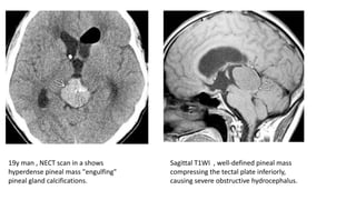 19y man , NECT scan in a shows
hyperdense pineal mass "engulfing"
pineal gland calcifications.
Sagittal T1WI , well-defined pineal mass
compressing the tectal plate inferiorly,
causing severe obstructive hydrocephalus.
 