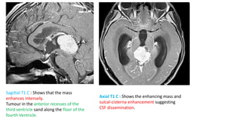 Sagittal T1 C : Shows that the mass
enhances intensely.
Tumour in the anterior recesses of the
third ventricle sand along the floor of the
fourth Ventricle.
Axial T1 C : Shows the enhancing mass and
sulcal-cisterna enhancement suggesting
CSF dissemination.
 