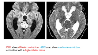 DWI show diffusion restriction. ADC map show moderate restriction
consistent with a high cellular mass.
 