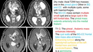 24y male: Axial T2WI two masses:
one in the pineal gland Other in BG
and CC with multiple cysts, some
with haemorrhages.
The BG-CC mass contain multiple
small cyst and a large cyst in the
left frontal lobe. The pineal mass
extends anteriorly into the medial
thalami
T1 C: The pineal , thalamic mass
enhances intensely.
The cyst walls of the BG-CC frontal
lobe mass also enhance.
Enhancing tumour along the
ependymal surfaces of the left
frontal horn and third
ventricle/thalami. This
is a germinoma.
 