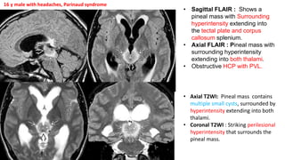 • Sagittal FLAIR : Shows a
pineal mass with Surrounding
hyperintensity extending into
the tectal plate and corpus
callosum splenium.
• Axial FLAIR : Pineal mass with
surrounding hyperintensity
extending into both thalami.
• Obstructive HCP with PVL.
• Axial T2WI: Pineal mass contains
multiple small cysts, surrounded by
hyperintensity extending into both
thalami.
• Coronal T2WI : Striking perilesional
hyperintensity that surrounds the
pineal mass.
16 y male with headaches, Parinaud syndrome
 