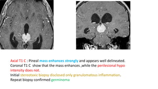 Axial T1 C : Pineal mass enhances strongly and appears well delineated.
Coronal T1 C show that the mass enhances ,while the perilesional hypo
intensity does not.
Initial stereotaxic biopsy disclosed only granulomatous inflammation.
Repeat biopsy confirmed germinoma
 