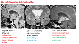 Sagittal T1WI :
Shows a
Isointense
sellar/suprasellar
mass , pineal
lesion.
Coronal T2WI : The
intra/suprasellar
mass appears
moderately
hypointense.
T1 C : Both masses
enhance strongly but
heterogeneously .
This is embryonal
carcinoma.
22y male headaches, diabetes insipidus
 
