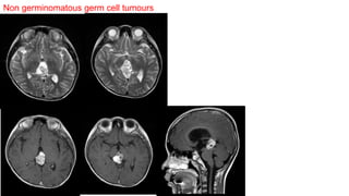 Non germinomatous germ cell tumours
 