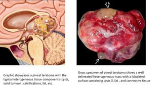 Graphic showcases a pineal teratoma with the
typica heterogeneous tissue components (cysts,
solid tumour , calcifications, fat, etc.
Gross specimen of pineal teratoma shows a well
delineated heterogeneous mass with a lobulated
surface containing cysts ﬅ, fat , and connective tissue
 
