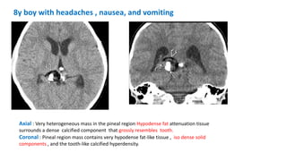 8y boy with headaches , nausea, and vomiting
Axial : Very heterogeneous mass in the pineal region Hypodense fat attenuation tissue
surrounds a dense calcified component that grossly resembles tooth.
Coronal : Pineal region mass contains very hypodense fat-like tissue , iso dense solid
components , and the tooth-like calcified hyperdensity.
 