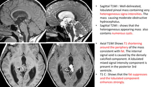 • Sagittal T1WI : Well-delineated,
lobulated pineal mass containing very
heterogeneous signa intensities. The
mass causing moderate obstructive
hydrocephalus.
• Sagittal T2WI : shows that the
heterogeneous appearing mass also
contains numerous cysts.
• Axial T1WI Shows T1 shortening
around the periphery of the mass
consistent with fat. The internal
signal void is caused by the densely
calcified component. A lobulated
mixed signal intensity component is
present in the posterior 3rd
ventricle.
• T1 C : Shows that the fat suppresses
and the lobulated component
enhances strongly.
 