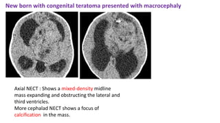New born with congenital teratoma presented with macrocephaly
Axial NECT : Shows a mixed-density midline
mass expanding and obstructing the lateral and
third ventricles.
More cephalad NECT shows a focus of
calcification in the mass.
 