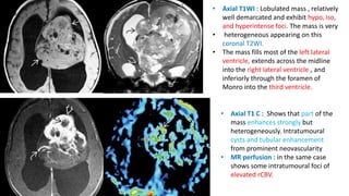 • Axial T1WI : Lobulated mass , relatively
well demarcated and exhibit hypo, iso,
and hyperintense foci. The mass is very
• heterogeneous appearing on this
coronal T2WI.
• The mass fills most of the left lateral
ventricle, extends across the midline
into the right lateral ventricle , and
inferiorly through the foramen of
Monro into the third ventricle.
• Axial T1 C : Shows that part of the
mass enhances strongly but
heterogeneously. Intratumoural
cysts and tubular enhancement
from prominent neovascularity
• MR perfusion : in the same case
shows some intratumoural foci of
elevated rCBV.
 