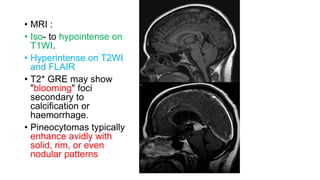 • MRI :
• Iso- to hypointense on
T1WI.
• Hyperintense on T2WI
and FLAIR
• T2* GRE may show
"blooming" foci
secondary to
calcification or
haemorrhage.
• Pineocytomas typically
enhance avidly with
solid, rim, or even
nodular patterns
 