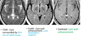 • T2WI : Cyst
surrounded by thin
rim of solid tissue.
• FLAIR : Cyst wall
enhancement , cyst
fluid didn’t
supress.
• Contrast: Cyst wall
enhancement.
 
