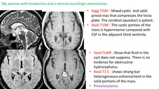 58y woman with headaches and a normal neurologic examination
• Sagg T2WI : Mixed cystic and solid
pineal mas that compresses the tecta
plate. The cerebral aqueduct is patent.
• Axial T1WI : The cystic portion of the
mass is hyperintense compared with
CSF in the adjacent third ventricle.
• Axial FLAIR : Show that fluid in the
cyst does not suppress. There is no
evidence for obstructive
hydrocephalus.
• Axial T1 C : shows strong but
heterogeneous enhancement in the
solid portions of the mass.
• Pinealocytoma.
 